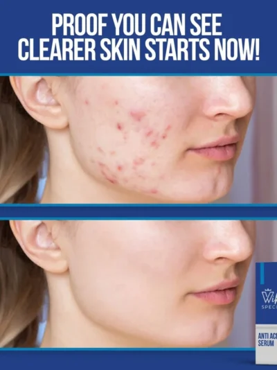 Wiki Special Anti Acne Serum 30ml | Clears Acne & Soothes Skin
